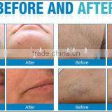 Laser Diode SL-808P With ChillTip Handpiece Provides the Ultimate in Epidermal Contact Cooling Hairy Removal Beauty Machine thumbnail-5