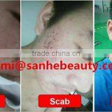 High Quality 10600nm Co2 Laser / RF Co2 Fractional Laser / Fractional Laser Co2 thumbnail-6