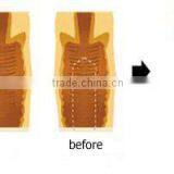 Hotting!!! Co2 Laser Medical Machine for Vaginal Tighten/vaginal Rejuvenation for Medical Use thumbnail-6