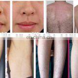 Million Clients Satisfied Diode Laser Hair Removal Machine/808nm Diode Laser Hair Removal thumbnail-5