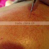 30 MHZ Spider Vein Vascular Removal Device/high Frequency Vascular Removal Device thumbnail-6