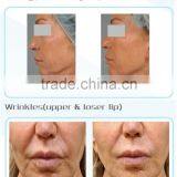 Latest Products in Market Korea High Intensive Focus Ultrasound HIFU thumbnail-4