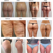 New Upgraded Inner Ball Roller Slim Endo Rollers Massaer Slimming Facial Lifting Body Shaping 8D Roller Beauty Machine thumbnail-6