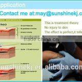 2016 Hot Sale Beauty Equipment q Switch nd Yag Laser Tattoo Removal thumbnail-5