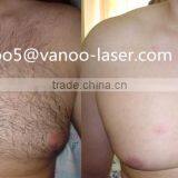 Ipl Epilator Portable Ipl Face Lifting Machine Chest Hair Removal thumbnail-6