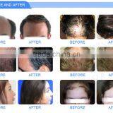 World Best Laser Hair Regrowth Hair Regrowth Products With 4 Pieces Treatment Panel thumbnail-6