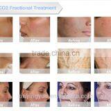 15W(20W) 8.0 Inch Multi-functional CO2 Fractional Laser Machine To Remove Chip 10.6um Portable thumbnail-5