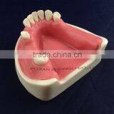 Medical Science Dental Implant Model With Soft Gingiva thumbnail-3