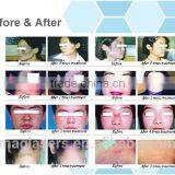 Wart Removal Low Price Multifunctional Co2 Laser Fractional Machine/laser Clinic And Medical Uses Vaginal Rejuvenation thumbnail-6