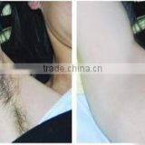 Most Effective Permanent 808nm Diode Laser Hair Removal Equipment With Factory Price thumbnail-4