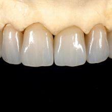 Crown & Bridge A Professional Outsourcing Dental Lab. thumbnail-3