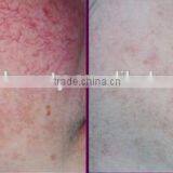 Professional Vascular Vein Stopper 980nm Varicose Veins Removal Diode Laser thumbnail-5