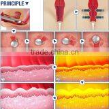 1.0-10mm 2016 Hot Selling Ultrasonic Hifu Vaginal Tightening Machine Skin Tightening thumbnail-5