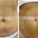 2016 Spring Promotion! Micro Needle RF Scar / Wrinkle Removal / Face Lift Fractional RF thumbnail-5