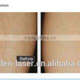 Factory Sale 808 Diode Hair Removal thumbnail-4