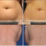 Most Professional Weight Loss Radio Frequency Vacuum Rf Weight Loss Cavitation Vacuum Slimming Vacuum Cavitation Fat Removal Machine Cavitation Weight Loss Machine thumbnail-6