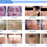 New Arrival Hot Selling CE Approved Device Skin Tag Removal Machine for Dark Circles thumbnail-6