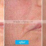 High Quality and Best Price Fractional C02 Laser Beauty Equipment Acne Treatment thumbnail-6