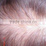 High Quality Hair Replacement thumbnail-1