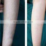 Portable 808nm Diode Laser Hair Rremoval Machine thumbnail-6