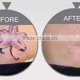 Competitive Q Switch Nd Yag Laser Tattoo Varicose Veins Treatment Removal Laser Machines Naevus Of Ota Removal thumbnail-3