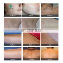 Ipl Hair Removal Machines Home Use thumbnail-3