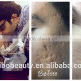 CO2 Fractional Laser for Scar Removal Skin Resurfacing and Vaginal Rejuvenation thumbnail-6