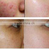 Co2 Laser High Quality And Best Price Fractional C02 Laser Tumour Removal Age Spot Removal Beauty Equipment Co2 Laser Scar Removal Acne Treatment Face Lifting Acne Removal thumbnail-5