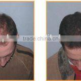 650nm Laser Hair Loss/ Hair Growth Machine (with CE Certification) thumbnail-4