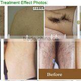 2016 Best Selling Beauty Spa Wanted Supplier Portable 808nm Diode Laser Permanent Hair Removal Machine Price thumbnail-6