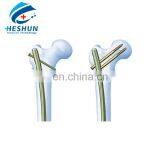 Humerus Interlocking Nail thumbnail-1