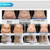50 / 60Hz Hottest 5 Handles Cryolipolysis Zeltiq Fat Freeze Cryolipolysis & Cavitation Slimming Machine thumbnail-3