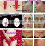 Supercritical Co2 Extraction Machine for Acne Scars Treatment , Burn Debridement thumbnail-5