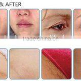 4MHZ Multifunctional Platform Hair Removal OPT High Frequency  SHR/ Face Lift Ultrasound HIFU Machine Forehead Wrinkle Removal thumbnail-6