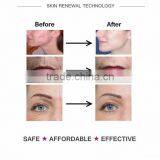 2016 Newest 4 in 1 Derma Roller 300 720 1200 Needles Stainless Micro Needle Therapy Derma Roller Dermaroller Anti Wrinkle Creme thumbnail-5