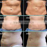 2017 Medical Safe and Comfortable Treatment Cryo 3 Handle , Cryo Fat Freeze Slimming Vacumm Fat Freezing Machine CL2 thumbnail-6