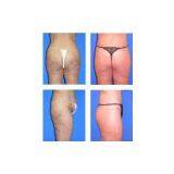 Slimming Machines Kumashape thumbnail-2