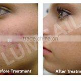 Acne Removal PDT LED Beauty Machine LED Phototherapy Beauty System Skin Rejuvenation thumbnail-4