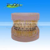 Orthodontic Teeth Model(Transparent Model , Normal Tooth, Common Brackets)/dental Orthodontic Models thumbnail-1