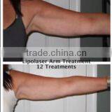 Home I-lipo Laser/ Laser Weight Lose Machine / Lipolisis Machine for Sale thumbnail-5