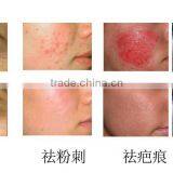Newest and Effective Fractional Radiofrequency Micro Needle thumbnail-5