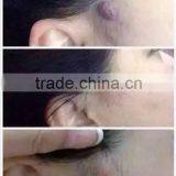 High Frequency Spot Removal Pen Speckle Removal thumbnail-4