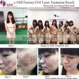 Eye Wrinkle / Bag Removal Website RF Excited Co2 Fractional Wart Removal Laser Machine For Skin Resurfacing (OD-C600) thumbnail-4