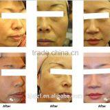 HIFU-C Home Use Hifu Ultrasound Wrinkle Removal Device for Face Lift thumbnail-2
