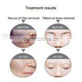 2016 New Products Looking for Distributors 532nm 1320nm 1064nm q Switched nd Yag Tattoo Removal Machine thumbnail-5