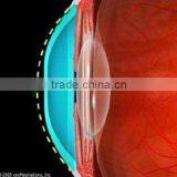 Digital Rigid Contact Lens for Corneal Reshape / MCT/ Luxuriant Metamorphosis of RGP Lenses thumbnail-1