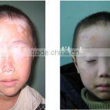 DERMA Hot Sale Home Use Narrowband 311nm UVB Phototherapy Lamps thumbnail-1