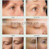 AYJ-C19(CE) Dot Matrix Portable rf Thermagic Galvanic Facial Machine thumbnail-6