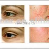 YUWEI Portable Medical Face Lift Scar Removal Machine With Micro Needle RF thumbnail-3