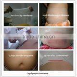 Cool Tech Fat Reduce Machine Beijing KES MED-340 thumbnail-3